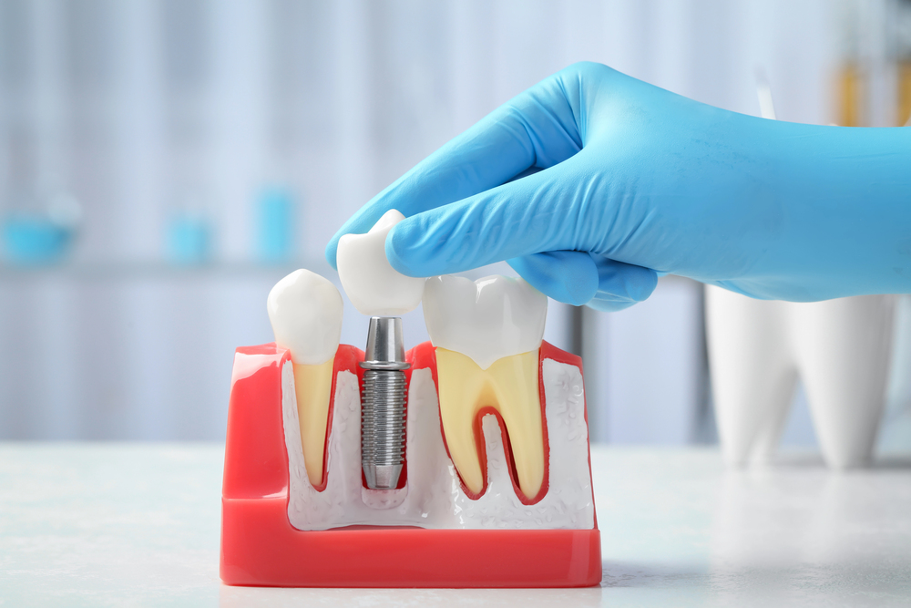 Dental Implant Crowns
