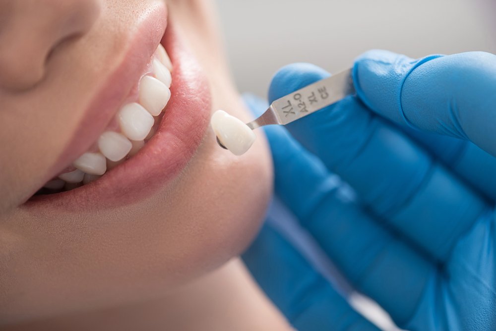 Single Tooth Replacement